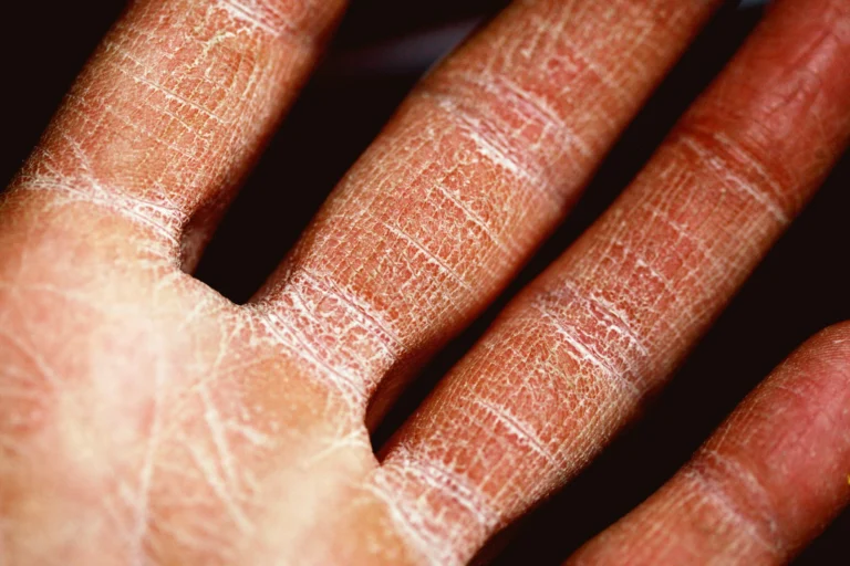 Behandlung von Ekzemen und Dermatitis beim Hautarzt in Konstanz