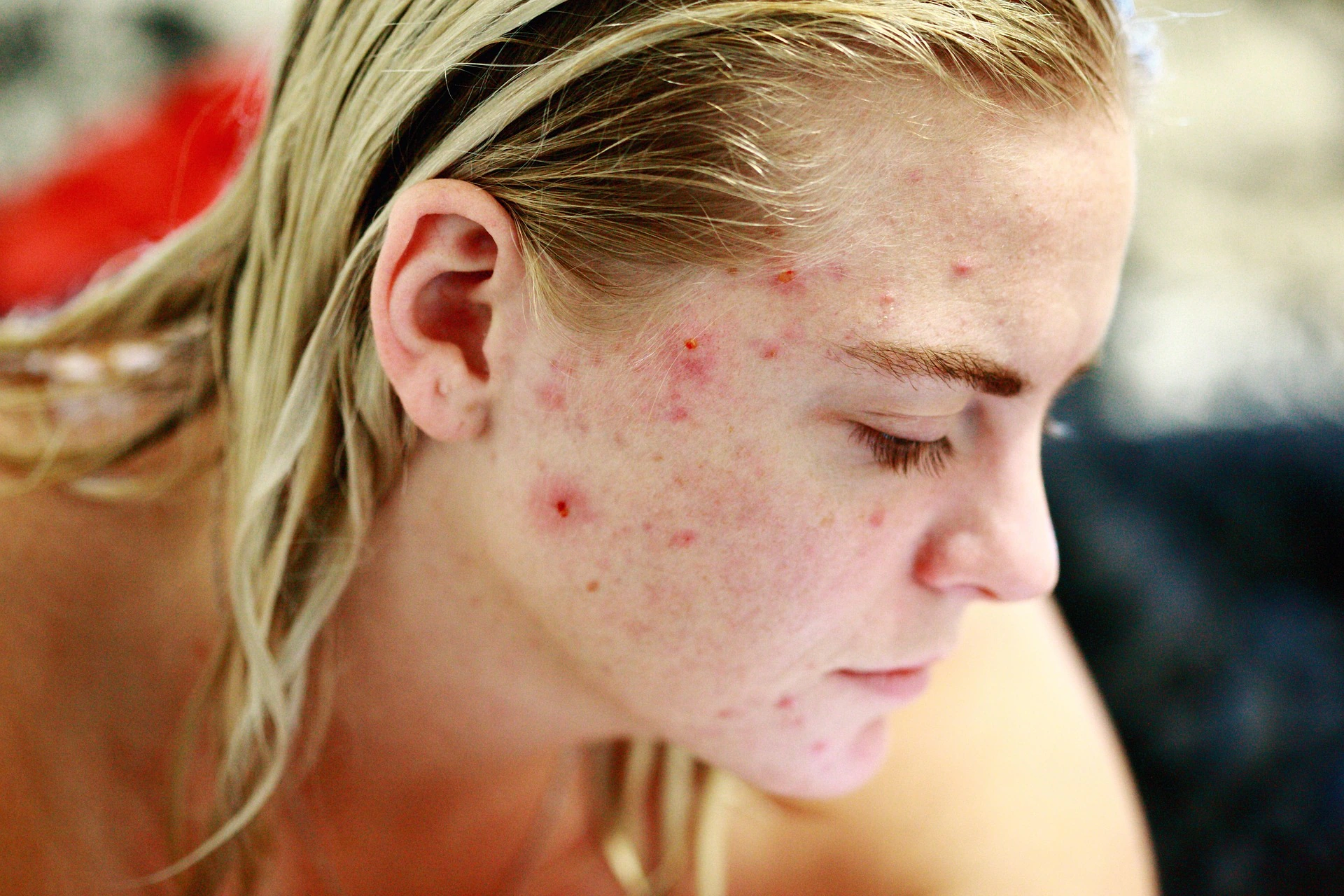Dermatologische Behandlung von Akne und Rosazea